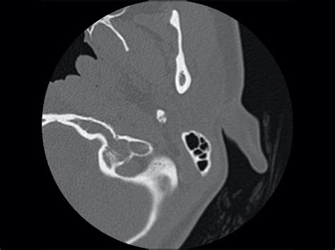 bones temp 9|ct temporal bone with contrast.